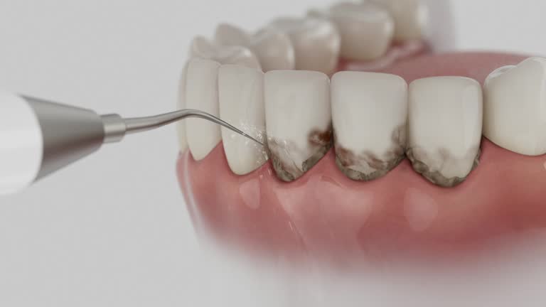 Trusted Tooth Extraction service in Montpelier, IN - Dentist Open Now